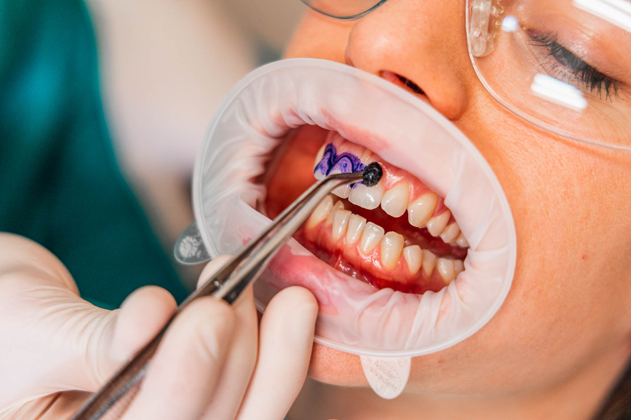 Una seduta di igiene orale professionale - Studio Dentistico Perucci